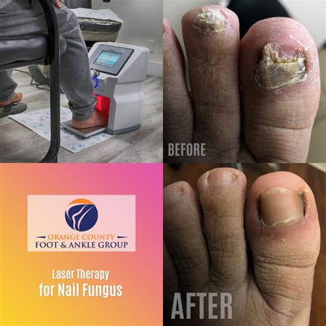 Laser Nail Fungus - OCFeet.com