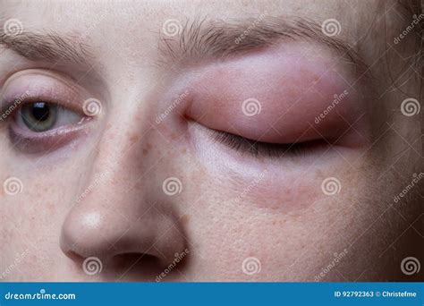 Allergic Reaction, Skin Rash, Close View Portrait Of A Girl`s Face ...
