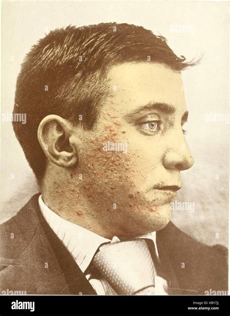 Comedo acne 0001 Stock Photo - Alamy
