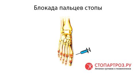 Блокада пальцев стопы в клинике Стопартроз - YouTube
