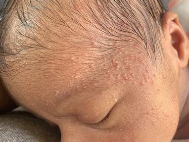heat rash  forehead baby