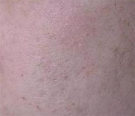 TCA Cross Peel Treatment For Acne Scars | Sasha Clinic
