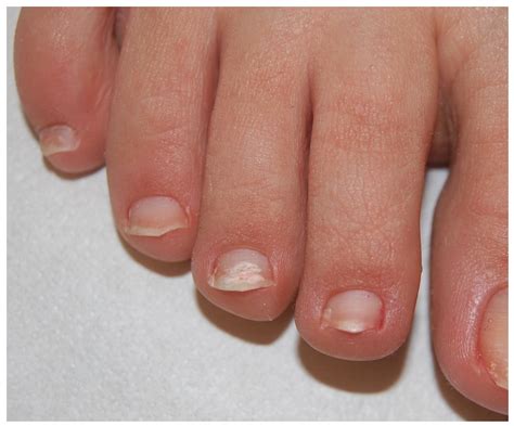 Early Onychomycosis Toe Nail Fungus – Symptoms, Causes And Home