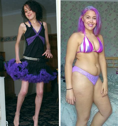Anorexic Men Before And After