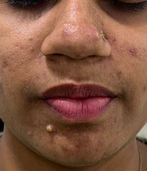 rid  pus filled pimples treat pimples  pus