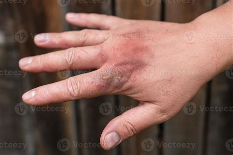 First degree skin burn. Hand burns, wounds. Hot boiling water acts on ...