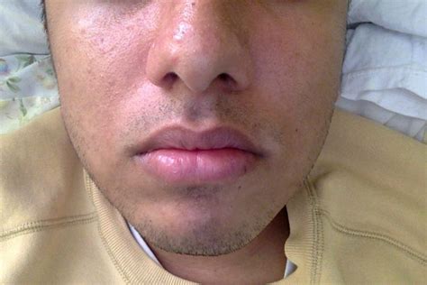 What Is This? (Pics Included) – General acne discussion – Acne.org Forum