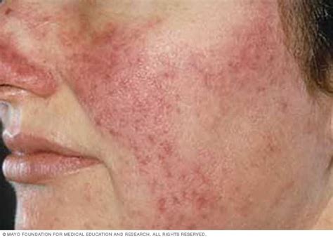 rosacea en piel blanca mayo clinic