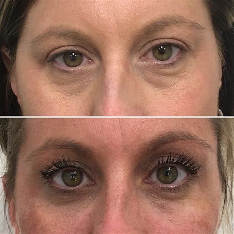 Latisse Before And After Eyebrows