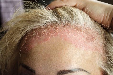 Como Tratar Seborreia Na Cabeça - Dermatite seborreica: O que é e como tratar?