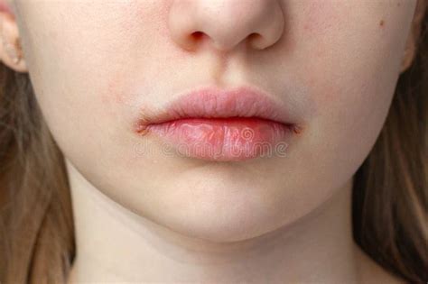 Close-up of Dry and Chapped Lips with Visible Irritation. a Close-up ...