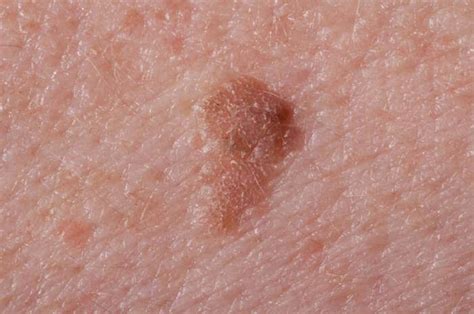 How to Remove Skin Keratosis At Home