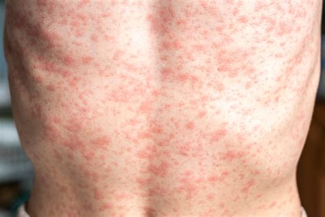 map shows alpha gal syndrome cases    lone star tick bite