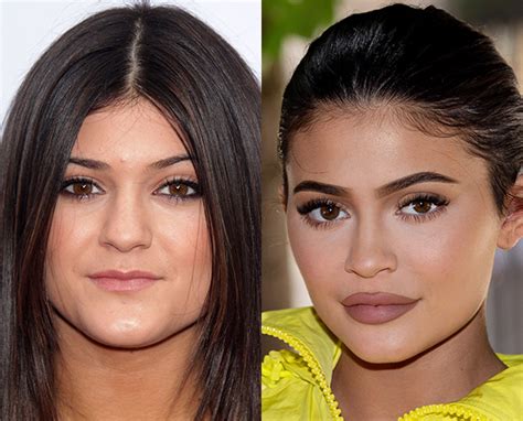 Kylie Jenner Before Plastic Surgery