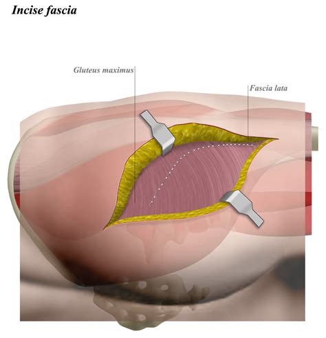 Hip Posterior Approach (Moore or Southern) - Approaches - Orthobullets