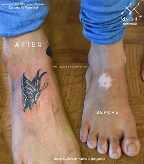 Vitiligo tattoo ideas photos