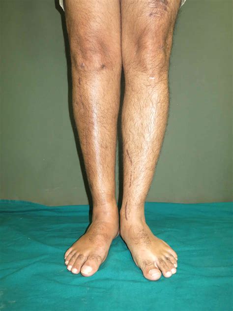 Limb Reconstruction Surgery Doctor in Coimbatore |Lower Limb