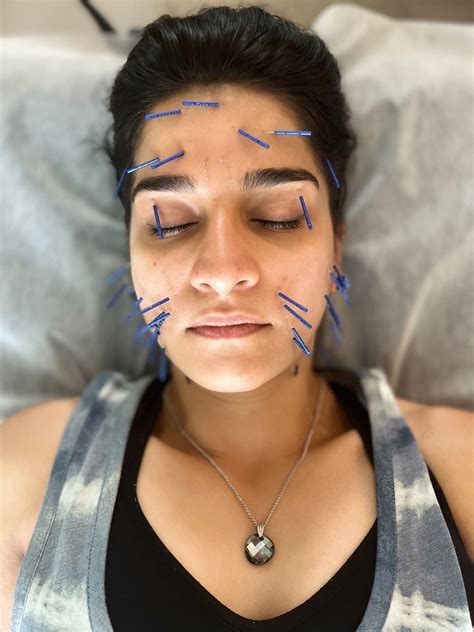 facial acupuncture lien   acupuncture