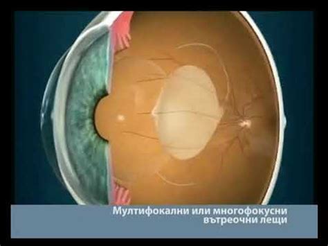 Мултифокални лещи - YouTube