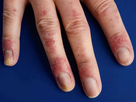 chilblains  symptoms  chilblains