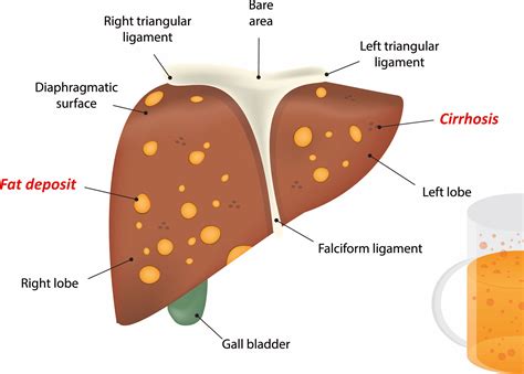 Liver Cirrhosis Alcohol
