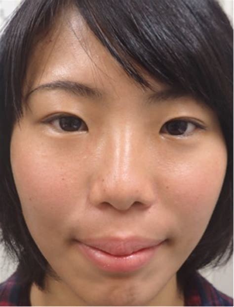 Young female patient with bilateral periorbital edema - European