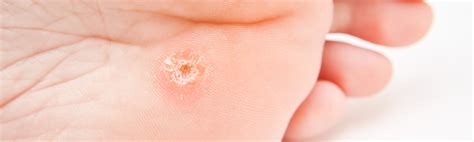 warts clemson iv bar aesthetics