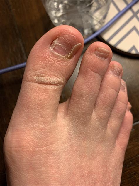 Painful Bump On Big Toe Knuckle at Pauline Jenkins blog