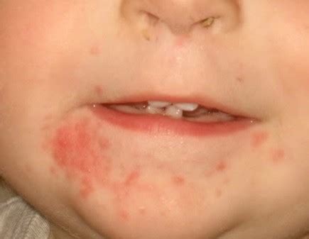 Teething Rash on Face - Symptoms, Causes, Treatment, Pictures