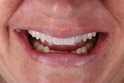 5 advantages of working with Bis-acryl Resin