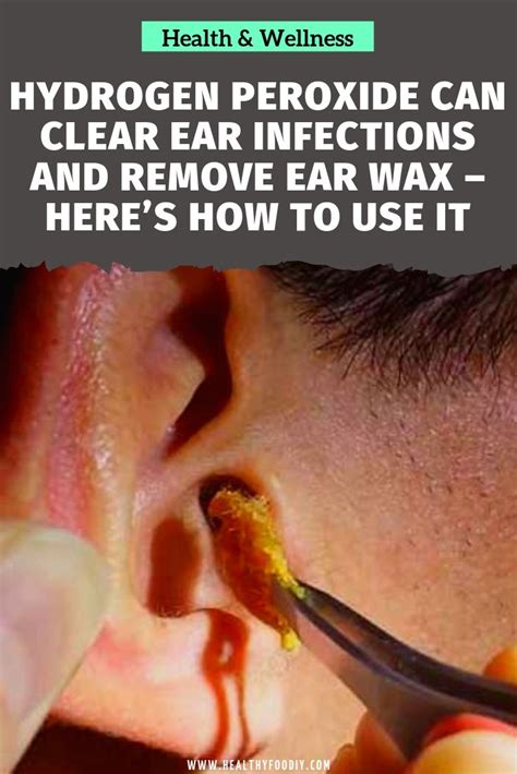 Is It Safe To Use Hydrogen Peroxide To Clean Ear Wax at Ann Burgess blog