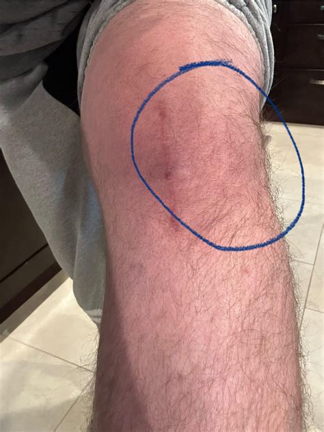 Knee Effusion Post Surgery : r/ACL