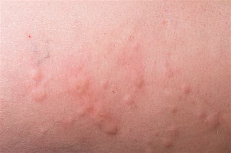 Skin Allergies - Dermatologist Singapore | Skin Specialist Clinic | RDSC