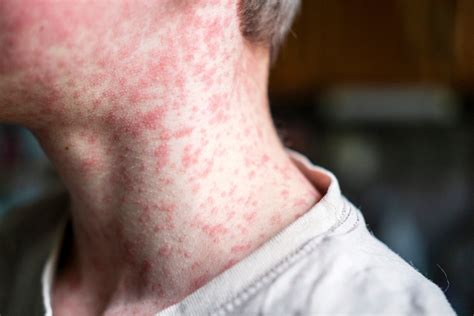 cdc accepts rsv recommendations    vaccine panel