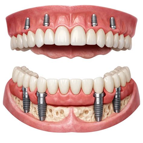 upper   dental implants complete guide