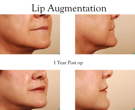 lip augmentation implants buildmyhealth