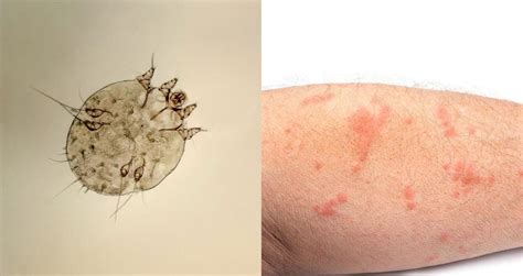 identifying bug bites  humans