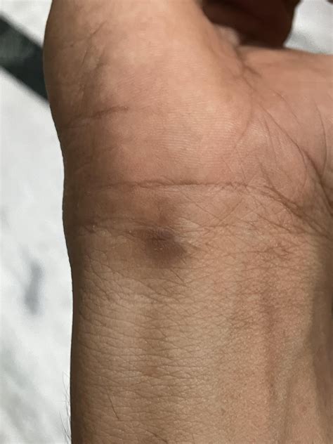 Blood clot in thumb finger and wrist after muscle up practice : r