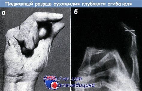 Лечение подкожных разрывов сухожилий сгибателей кисти