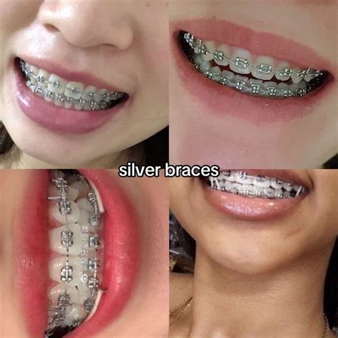 silver braces color teeth gems  retainers  teeth braces teeth