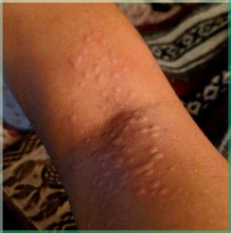 Eliminate Hives Naturally: 6 Helpful Remedies | Hives, Allergy hives ...