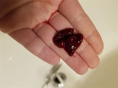 How Does A Miscarriage Look At 6 To 8 Weeks