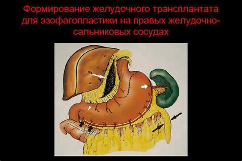Рак пищевода Рак пищевода Аденокарцинома пищевода