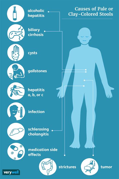 What Can Cause Pale Stool or Clay-Colored Stool?