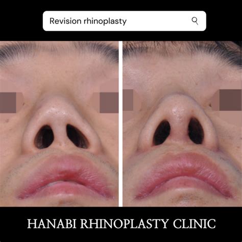 nostrils asymmetry revision  rhinoplasty hanabi rhinoplasty clinic