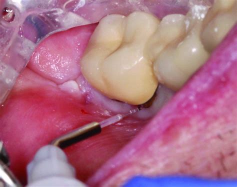 Utilizing a Soft Tissue Diode Laser for a Direct Resin Restoration