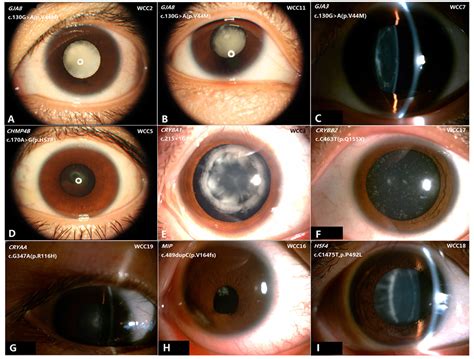 Cortical Cataract