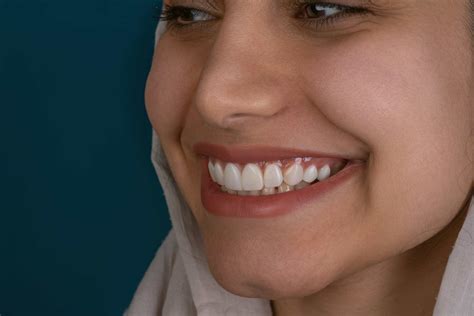 Do Braces Change Your Jaw & Alignment? - Alpan Orthodontics