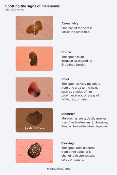 abcde  skin cancer