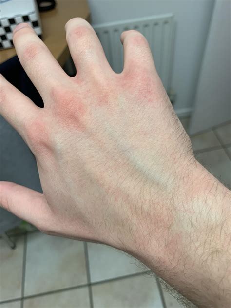 I think I’ve had my first allergic reaction, any advice? : r/Allergies
